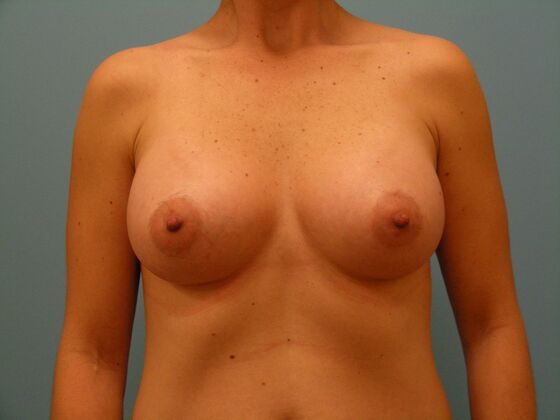 Breast Augmentation High Profile Allergan Implants - Breast Augmentation - Gilbert, AZ - After