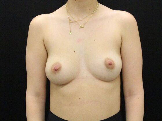 Breast Augmentation Case 50 - Before