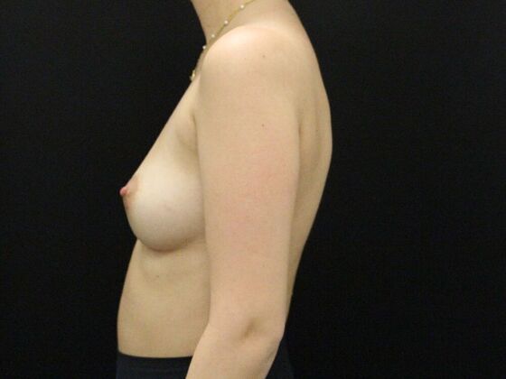 Breast Augmentation: Case 50 - Before