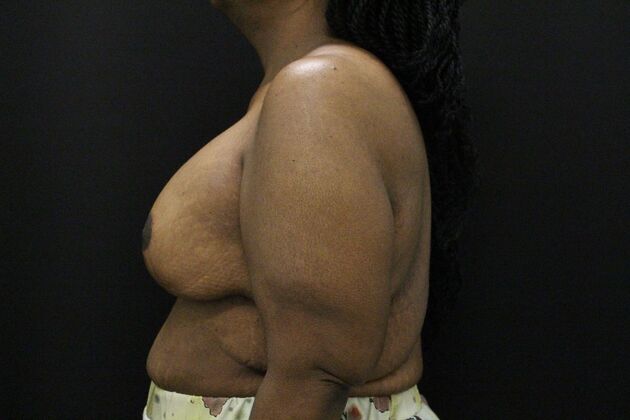 Breast Lift & Breast Lift Augmentation: Case 56 - After