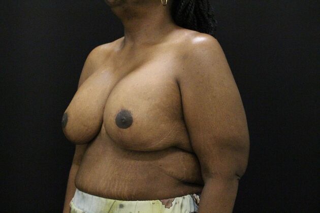 Breast Lift & Breast Lift Augmentation: Case 56 - After