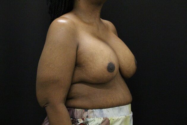 Breast Lift & Breast Lift Augmentation: Case 56 - After