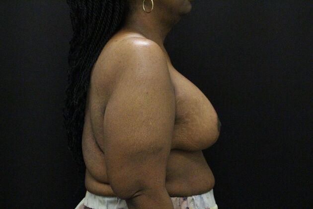 Breast Lift & Breast Lift Augmentation: Case 56 - After