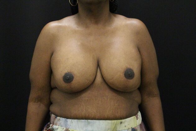 Breast Lift & Breast Lift Augmentation Case 56 - After