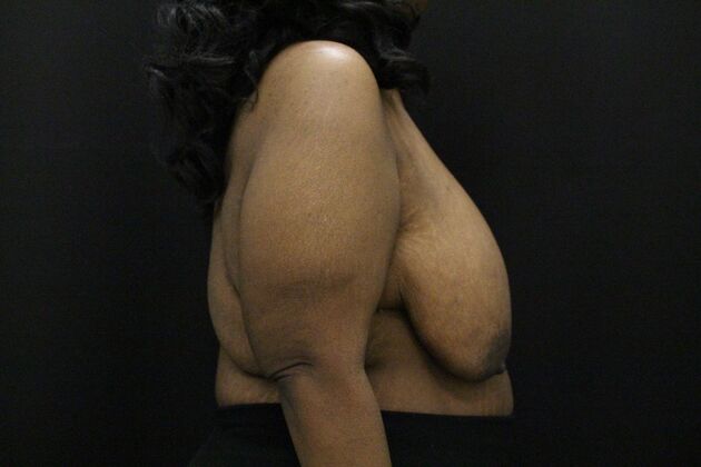 Breast Lift & Breast Lift Augmentation: Case 56 - Before