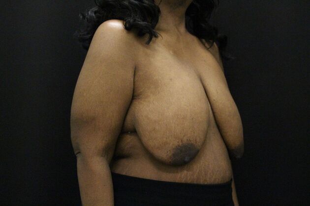 Breast Lift & Breast Lift Augmentation: Case 56 - Before