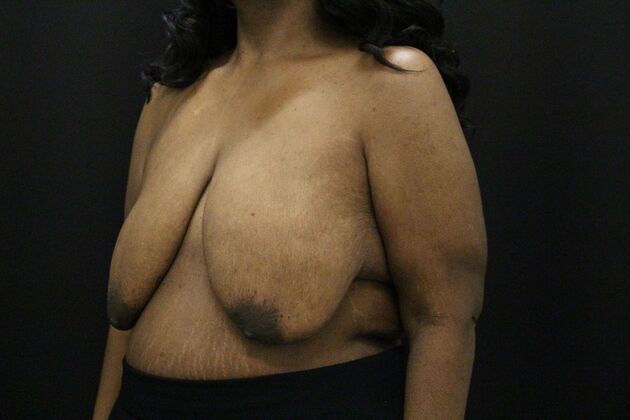 Breast Lift & Breast Lift Augmentation: Case 56 - Before