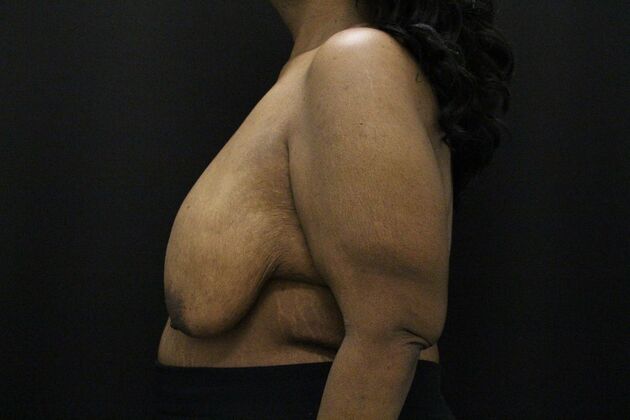 Breast Lift & Breast Lift Augmentation: Case 56 - Before