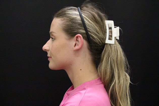 Otoplasty: Case 5 - After