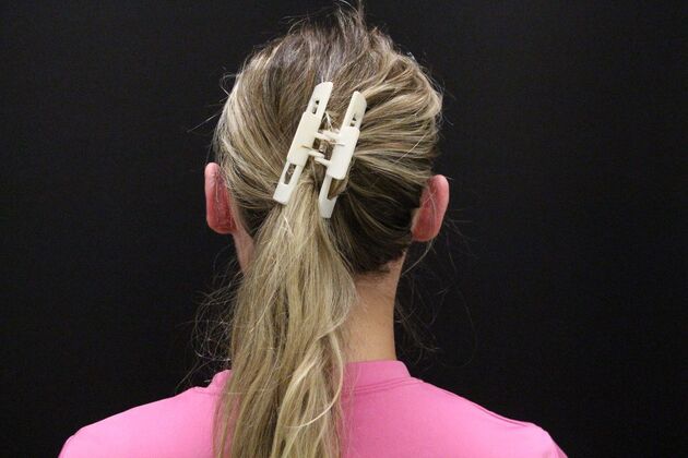 Otoplasty Case 5 - After