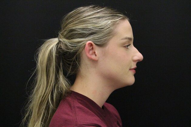 Otoplasty: Case 5 - Before