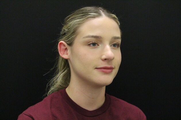 Otoplasty: Case 5 - Before