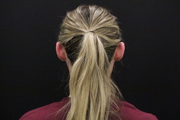 Otoplasty Case 5 - Before