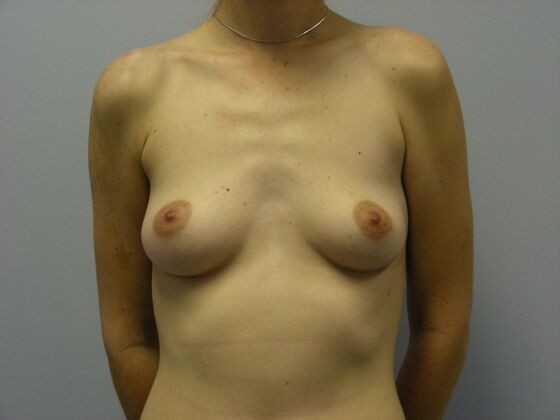 Breast Augmentation High Profile Saline Implants - Breast Augmentation - Scottsdale, AZ - Before