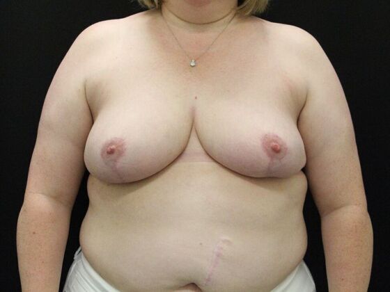 Breast Reduction & Lift Case 33 - After