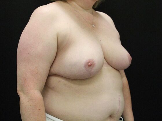 Breast Reduction & Lift: Case 33 - After
