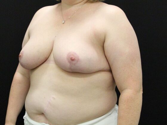 Breast Reduction & Lift: Case 33 - After