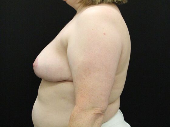 Breast Reduction & Lift: Case 33 - After