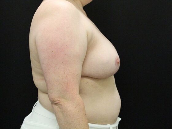 Breast Reduction & Lift: Case 33 - After