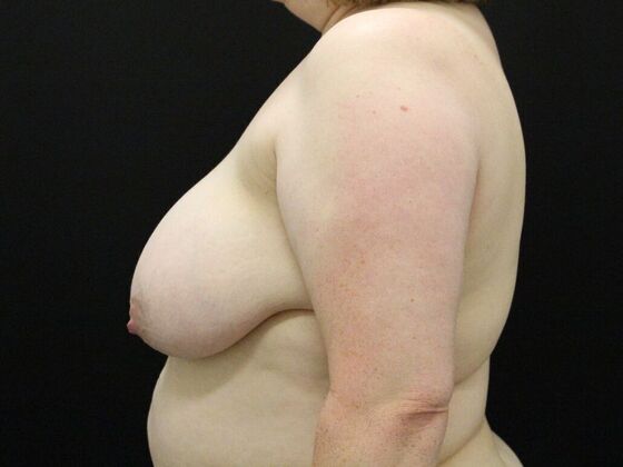 Breast Reduction & Lift: Case 33 - Before
