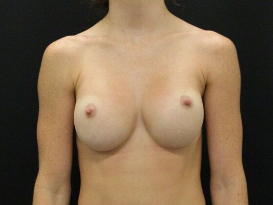 Breast Revision Case 13 - After