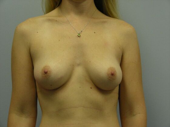 Breast Augmentation Breast Augmentation Case 4 - Before