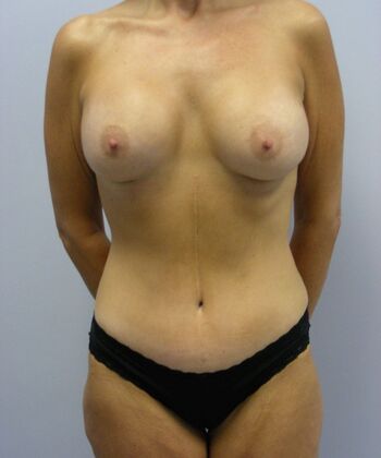 Body Contouring Breast Augmentation, Tummy Tuck, Inner Thigh Lift, Arm Lift - Body Contouring - Phoenix, AZ - After