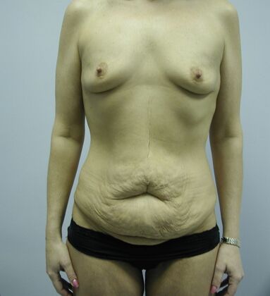 Body Contouring Breast Augmentation, Tummy Tuck, Inner Thigh Lift, Arm Lift - Body Contouring - Phoenix, AZ - Before