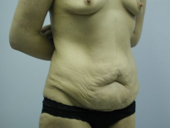 Body Contouring: Breast Augmentation, Tummy Tuck, Inner Thigh Lift, Arm Lift - Body Contouring - Phoenix, AZ - Before