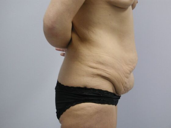 Body Contouring: Breast Augmentation, Tummy Tuck, Inner Thigh Lift, Arm Lift - Body Contouring - Phoenix, AZ - Before
