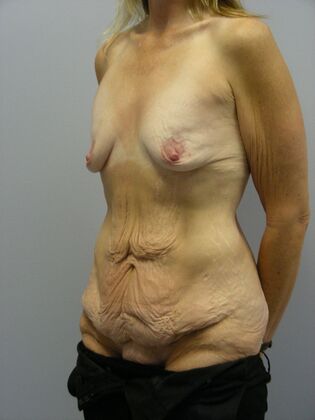 Body Contouring: Body Contouring Case 2 - Before