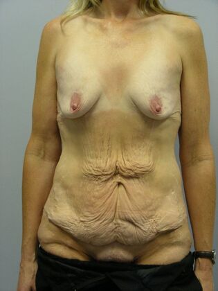 Body Contouring Body Contouring Case 2 - Before