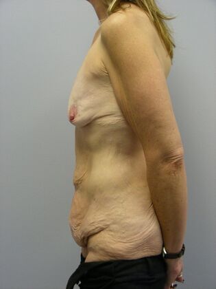 Body Contouring: Body Contouring Case 2 - Before