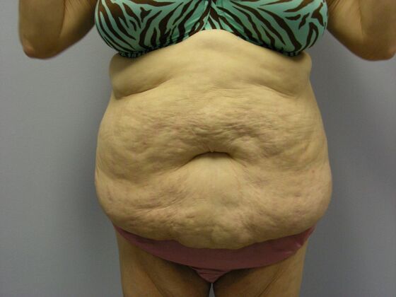 Body Contouring Tummy Tuck with Liposuction, Arm Lift, Breast Augmentation, Breast Lift - Body Contouring - Scottsdale, AZ - Before