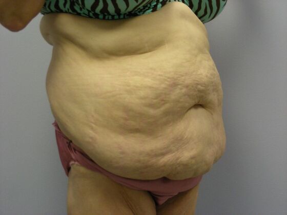 Body Contouring: Tummy Tuck with Liposuction, Arm Lift, Breast Augmentation, Breast Lift - Body Contouring - Scottsdale, AZ - Before
