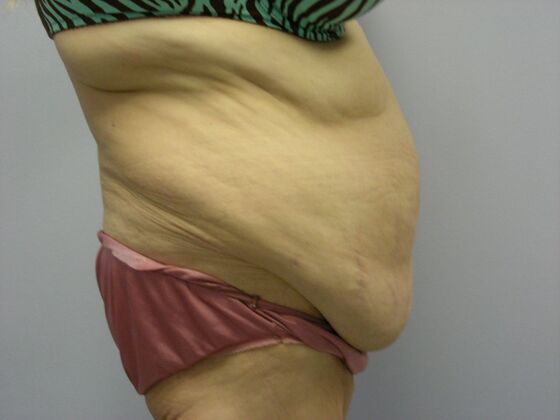 Body Contouring: Tummy Tuck with Liposuction, Arm Lift, Breast Augmentation, Breast Lift - Body Contouring - Scottsdale, AZ - Before
