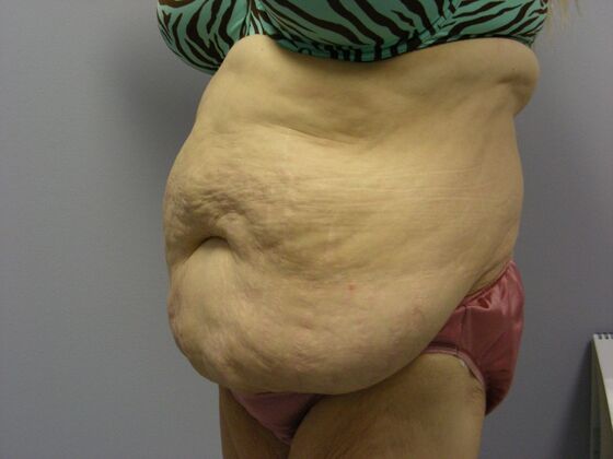 Body Contouring: Tummy Tuck with Liposuction, Arm Lift, Breast Augmentation, Breast Lift - Body Contouring - Scottsdale, AZ - Before