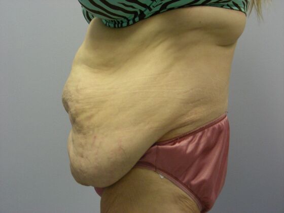 Body Contouring: Tummy Tuck with Liposuction, Arm Lift, Breast Augmentation, Breast Lift - Body Contouring - Scottsdale, AZ - Before
