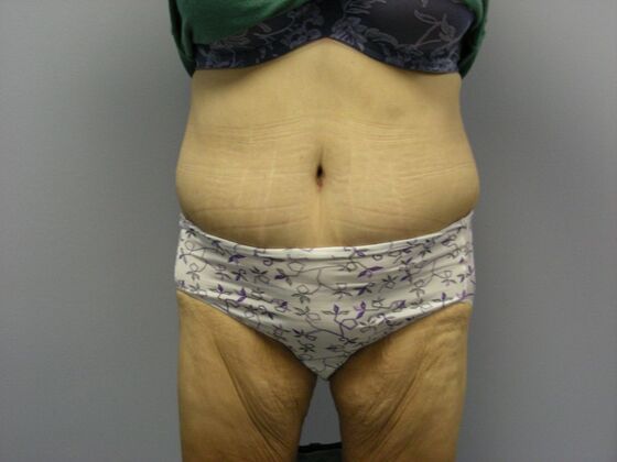 Body Contouring Tummy Tuck with Liposuction, Arm Lift, Breast Augmentation, Breast Lift - Body Contouring - Scottsdale, AZ - After