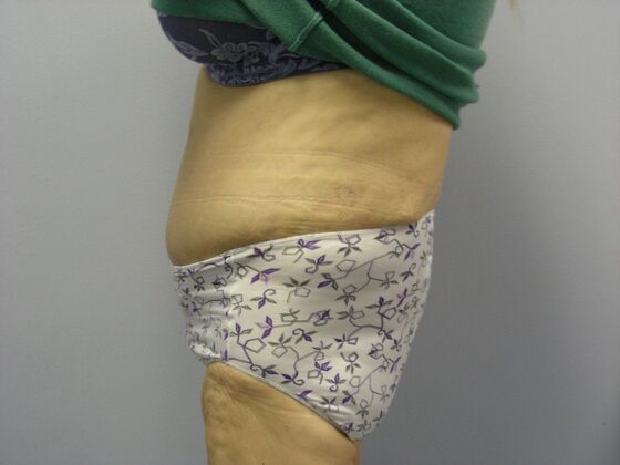 Body Contouring: Tummy Tuck with Liposuction, Arm Lift, Breast Augmentation, Breast Lift - Body Contouring - Scottsdale, AZ - After