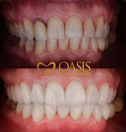Smile Transformations Cases