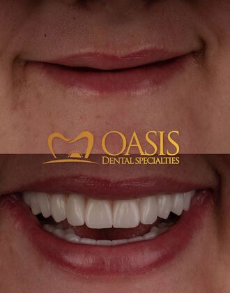 Smile Transformations Case 4