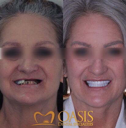 Smile Transformations Case 7