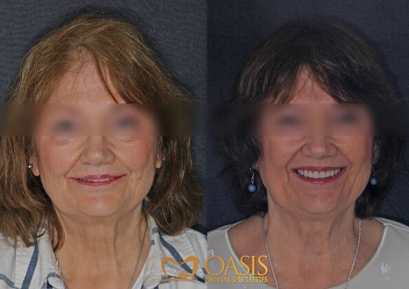 Smile Transformations Case 8