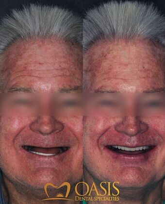 Smile Transformations Case 9