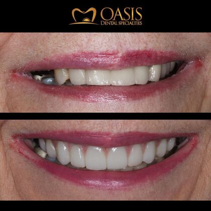 Smile Transformations Case 11