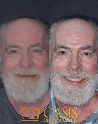 Smile Transformations Case 12