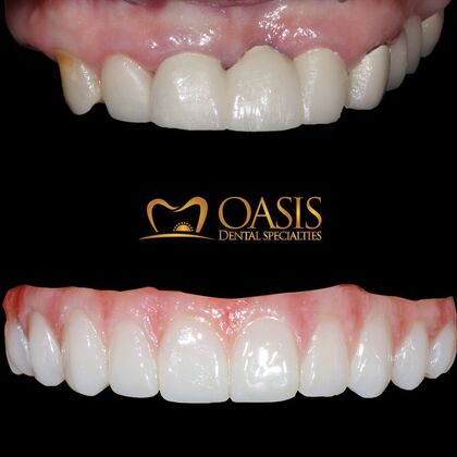 Smile Transformations Case 13