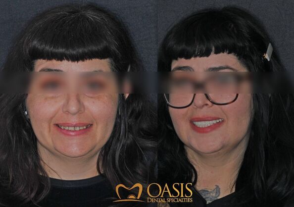 Smile Transformations Case 14