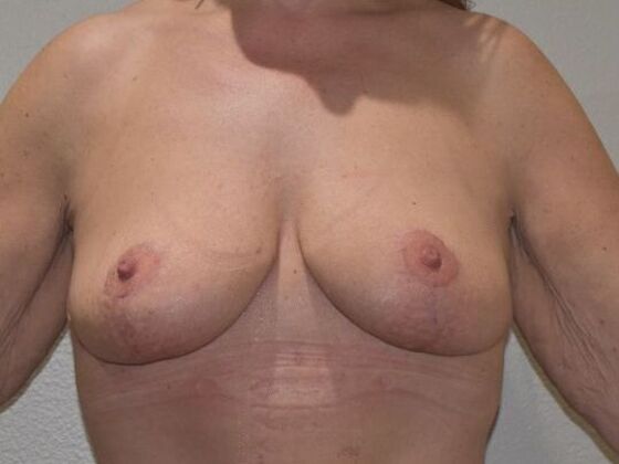 Breast Augmentation Case 794 - Before
